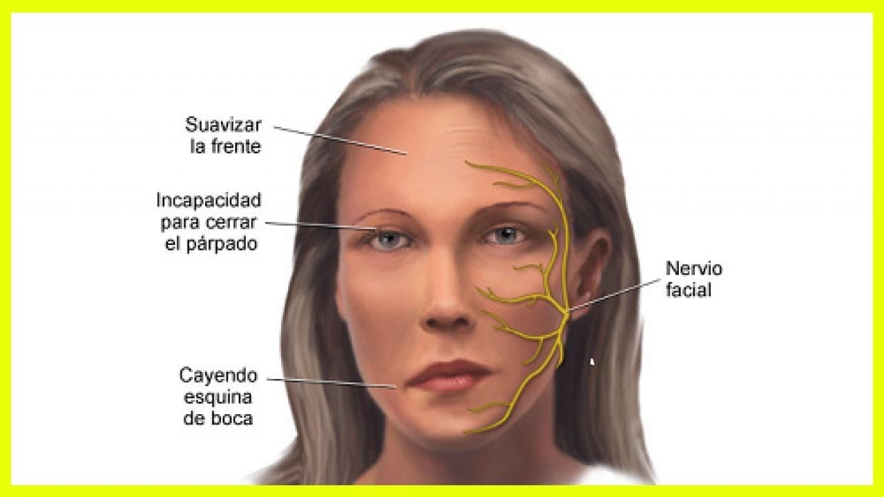 Неврит лицевого нерва отзывы