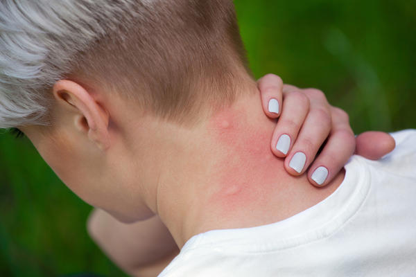 Для страдающего от комариной аллергии множественные укусы могут привести к летальному исходу
