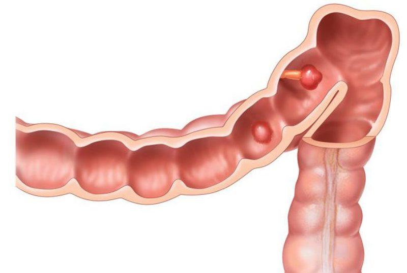 Новообразования в кишечнике