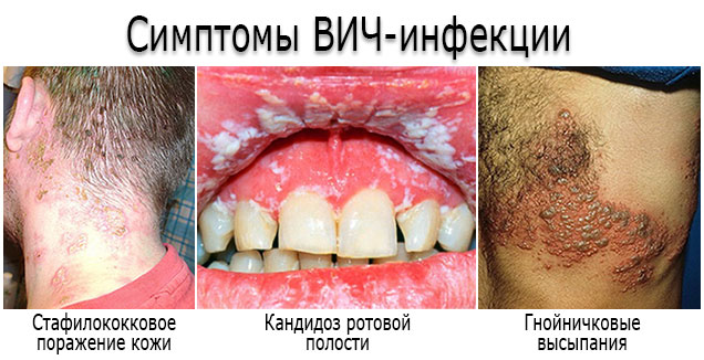 симптомы спида фото