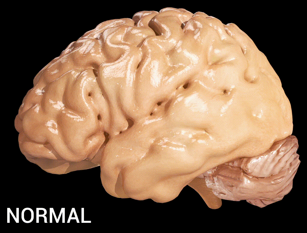Дегенеративные заболевания мозга. Головной мозг. Старение мозга.